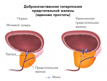 220x167-equal_images_articles_adenoma_prostaty