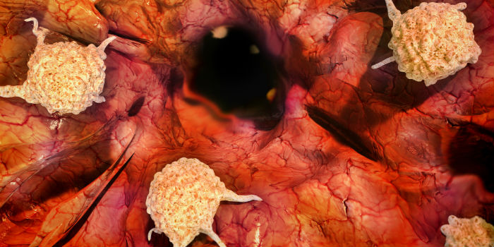Как распространяются раковые клетки в поджелудочной железе