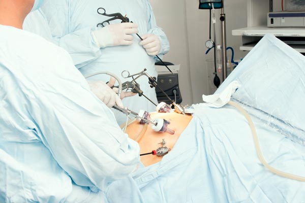 laparoskopia