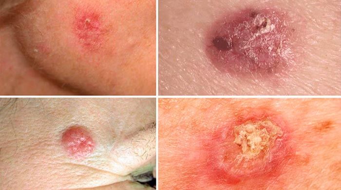 Как выглядит базальноклеточный рак кожи?