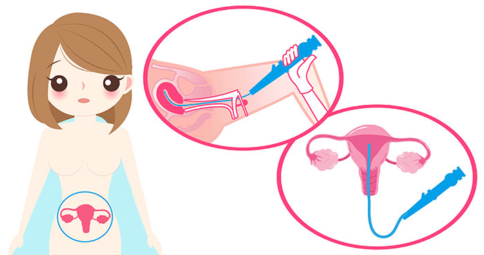 Гистероскопия лечебная при миоме матки