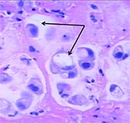 Перстневидноклеточный рак желудка метастазы thumbnail