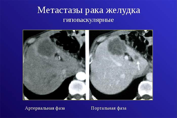 На какой стадии рака желудка появляются метастазы thumbnail