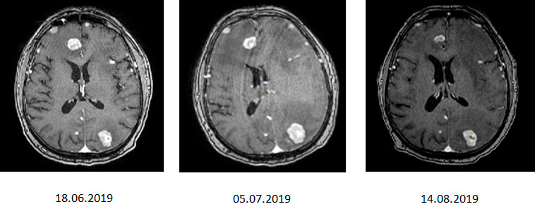Меланома метастазы в головной мозг прогноз thumbnail