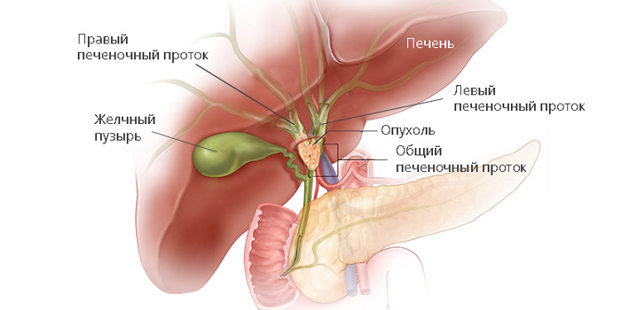 Опухоль Клацкина