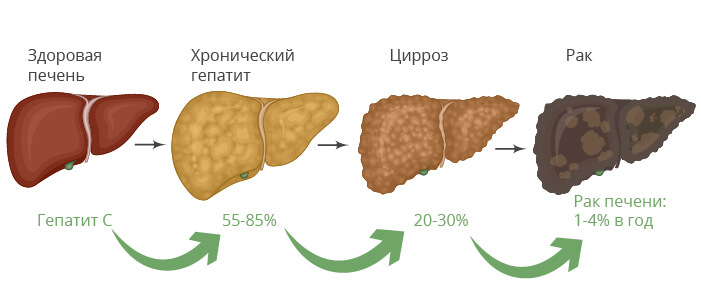 Перерождение печени при вирусном гепатите С