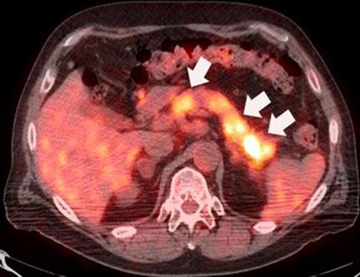 Рак тела поджелудочной железы 4 стадии thumbnail