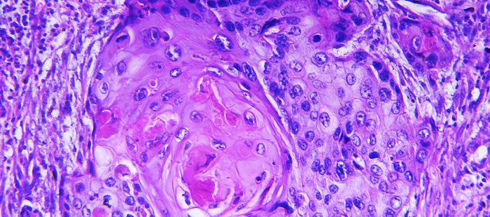 плоскоклеточный рак микрофотография