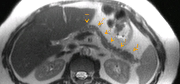 4 стадия рака головки поджелудочной железы прогнозы thumbnail