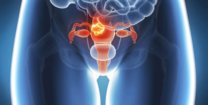 Рак матки и метастазы в позвоночник симптомы