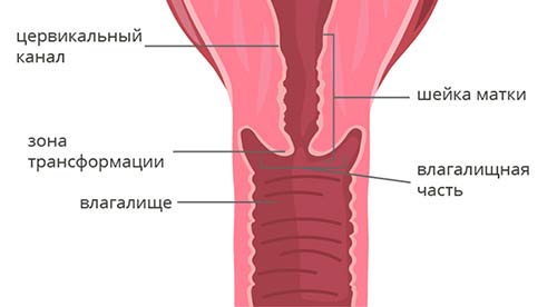 Клиническая картина рака шейки матки
