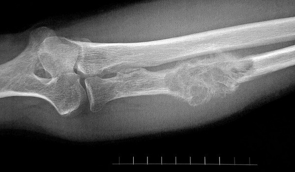 Рак кости на рентгеновском снимке