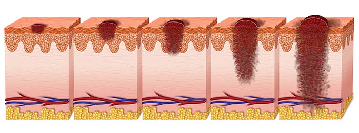 Признаки узловой меланомы кожи