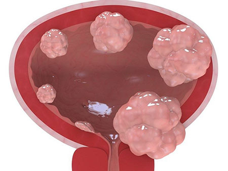 Лечение инвазивного рака мочевого пузыря thumbnail