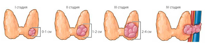 Стадии рака щитовидной железы