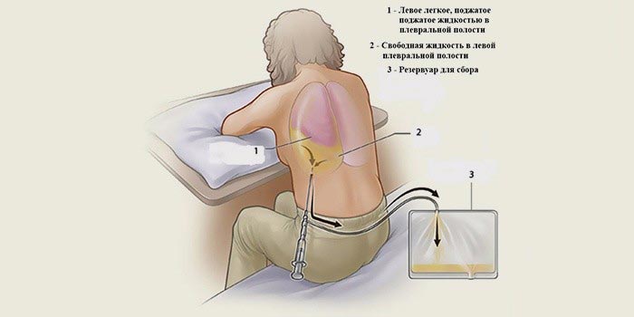 Синдром свободной жидкости в плевральной полости